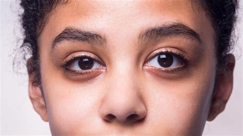 What is Brown Syndrome? - Family Medicine News