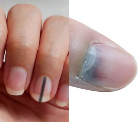 Do You Know Having Black Lines On Your Nails Can Kill?| Globecalls.Com