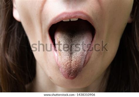 Xerostomia: Over 25 Royalty-Free Licensable Stock Photos | Shutterstock