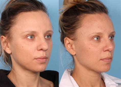 6 Things That Surprised Me About My Rhinoplasty | RealSelf News