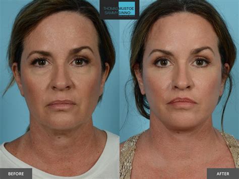 8 Facelift Before-and-After Photos That Prove Just How Natural Today’s Results Look | TLKM ...