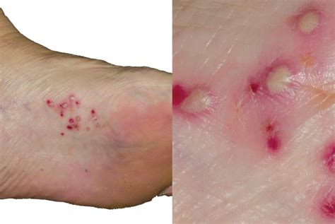 Differential diagnoses: Skin conditions of the feet | GPonline