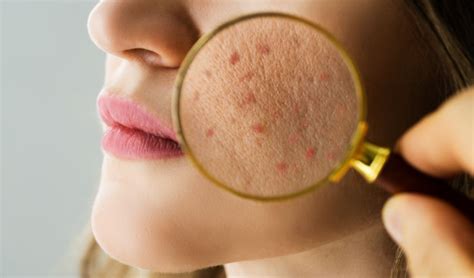 Understanding Acne and Other Common Skin Problems: Causes, Symptoms, and Treatments - EdRanks ...