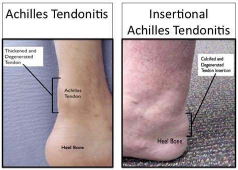 Achilles Pain - Robbie Ray | Foot & Ankle Surgeon