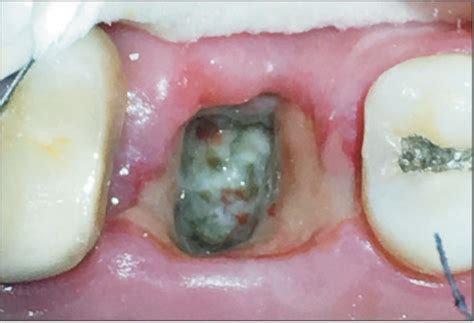 White Stuff in Tooth Extraction Hole