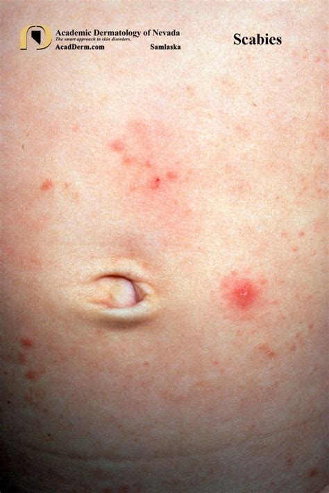 Parasitic Diseases: Scabies - Academic Dermatology of Nevada