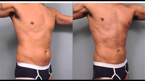 Liposuction Gone Wrong Men