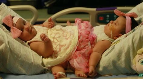 Conjoined Texas twins, Ximena and Scarlett Hernandez-Torres, get set for separation surgery ...