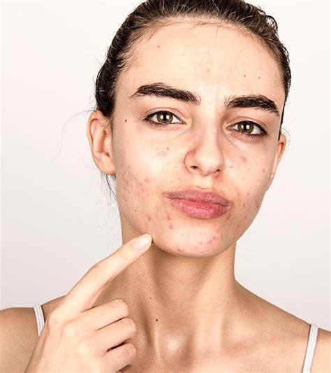 Hormonal Acne: Causes, How To Treat It, And Foods To Avoid