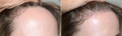 Forehead Reduction Surgery photos | Miami, FL | Patient124414