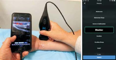 Figure 2 from CMUT/CMOS-based Butterfly iQ - A Portable Personal Sonoscope | Semantic Scholar