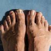 Fungal Infection Awareness Month — Precision Foot and Ankle Centers
