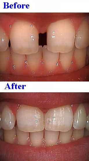 Bonding gaps between teeth with high end composite resins.