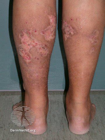 Calciphylaxis | Kidney Care UK