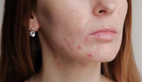 How To Cure Hormonal Acne-The Must-Know Tips For Chin!