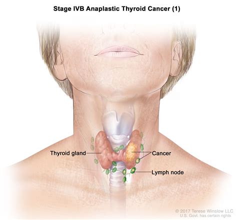 Thyroid Cancer Treatment (PDQ®)–Patient Version - NCI