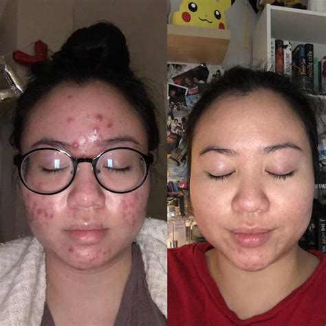 [Before&After] My Cystic Acne Journey! : r/SkincareAddiction