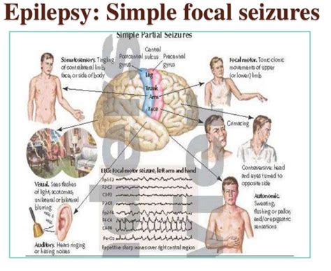 epilepsy