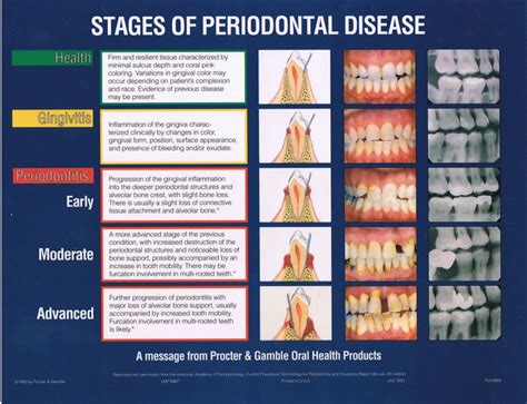 Stages of periodontal disease. #dentistry | Dental assistant study, Dental hygiene school ...