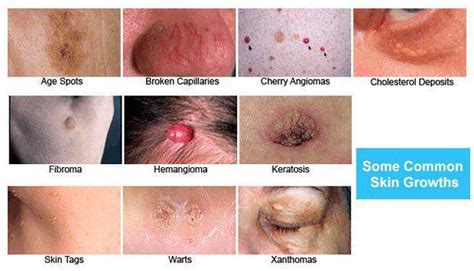 Common Skin Growths – A Dermatologist’s Perspective