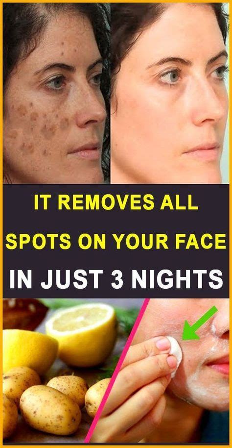 30 Natural Home Remedies To Remove Acne Scars Overnight - Fashion Blog ...