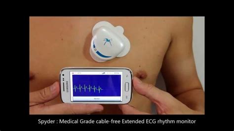 Spyder ECG: Self-administered, 'Live-stream' Continuous ECG to Cloud for Physician review - YouTube