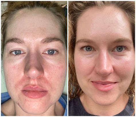 Tretinoin Before and After Photos: How Do You Know it Will Work for Yo – Dear Brightly