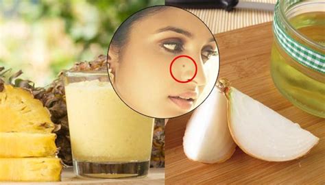 Mole Removal Home Remedy Garlic - Homemade Ftempo