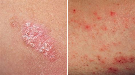 Key Differences Between Eczema and Psoriasis