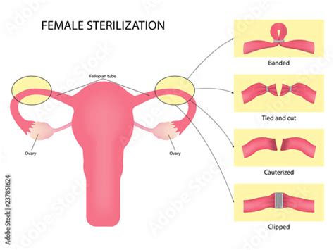 An Overview of Tubal Ligation Surgery as a Form of Female Sterilization ...