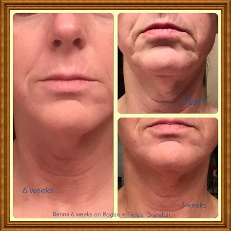 Rodan + Fields before and after. Amazing results!!! | Rodan and fields ...