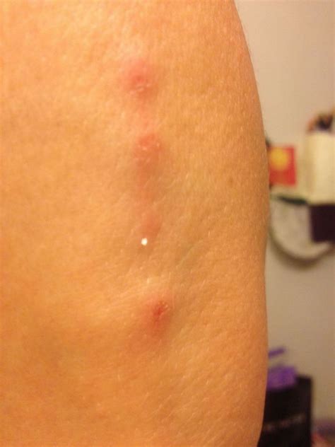 Parasites or Scabies or both? Stumped. One BIG Walking Infestation ...