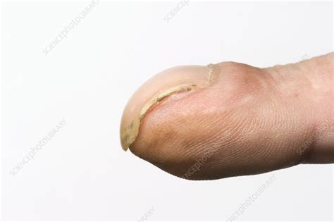 Clubbed fingernails - Stock Image - C010/3262 - Science Photo Library