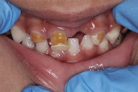 What is Early Childhood Caries? Causes & Treatment.