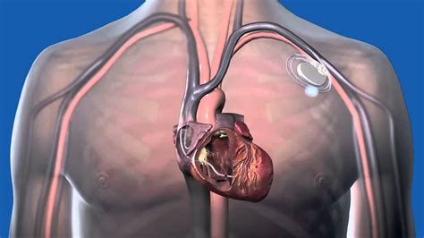 What is a pacemaker ? - YouTube