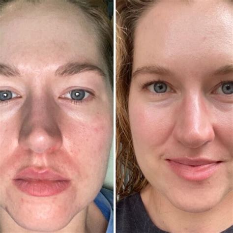 Retinol Before and After: Transform Your Skin with These Results - Must Read This Before Buying