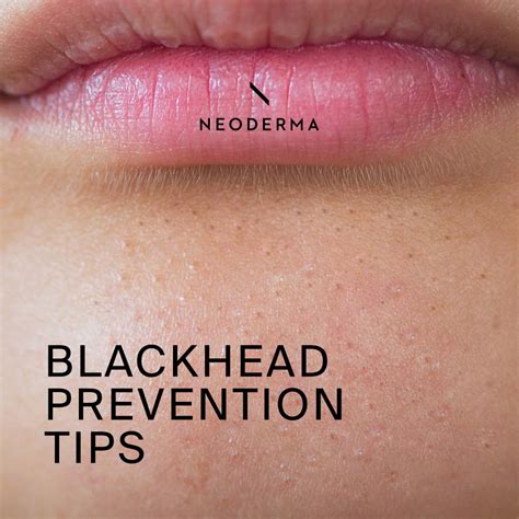 Blackhead Prevention Tips – NEODERMA