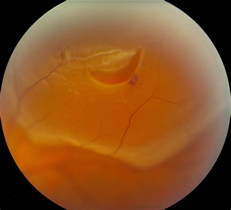 Vitreous Syneresis Treatment