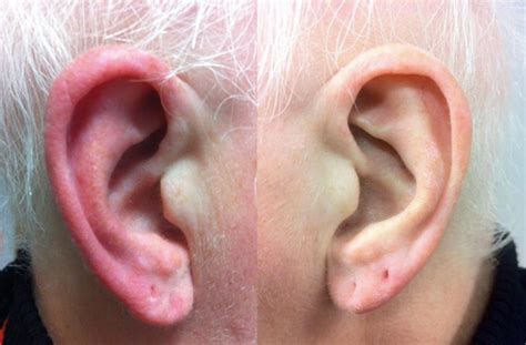 What Is Red Ear Syndrome?