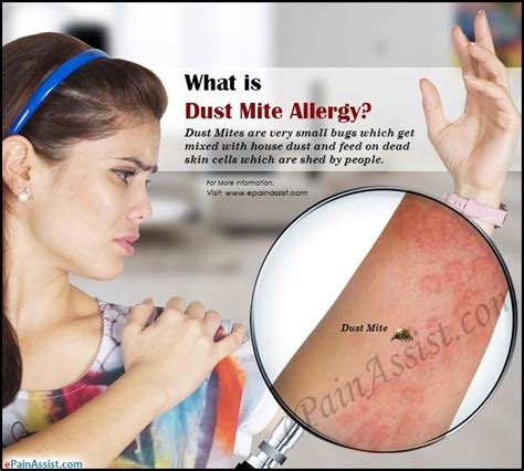 Signs you are Allergic to Dust | Dust mite allergy, Dust mite allergy remedies, Dust mites