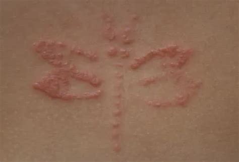Allergic Dermatitis Rash