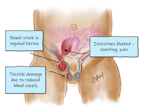 Testicular Hernia