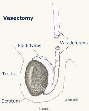 Vasectomy Reversal - Northern California Fertility Medical Center