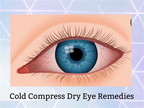 Cold Compress Dry Eye Remedies