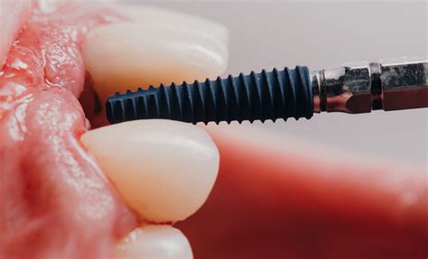 Understanding The Osseointegration Process : Garran Dental