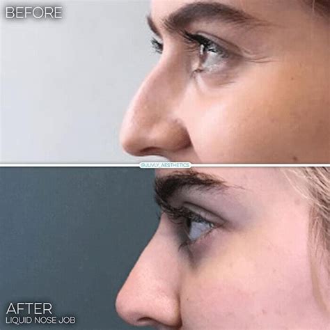 Juvly Aesthetics: Painless Non-Surgical Liquid Nose Job