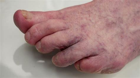 Mottled Skin (Livedo Reticularis): Causes, Signs, and Treatment