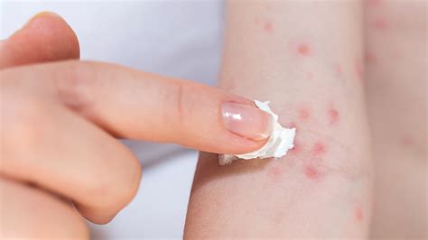 Treating An Allergic Skin Reaction (Contact Dermatitis), 50% OFF