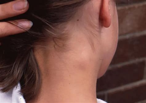 A Knot in Your Neck: 3 Causes & 6 Treatments - Elder VIP