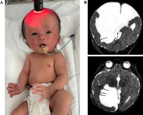 Diagnosis of hydrocephalus by cranial transillumination | ADC Fetal & Neonatal Edition